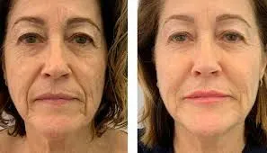 Armonización facial: el protocolo que recalibra la arquitectura del rostro